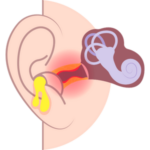 Ear Wax Treatment: Dr. Enu Malik Kukreja, ENT Specialist in Andheri, Mumbai