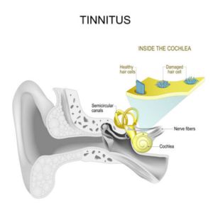 Tinnitus / Ringing Ears - Dr. Enu Malik Kukreja