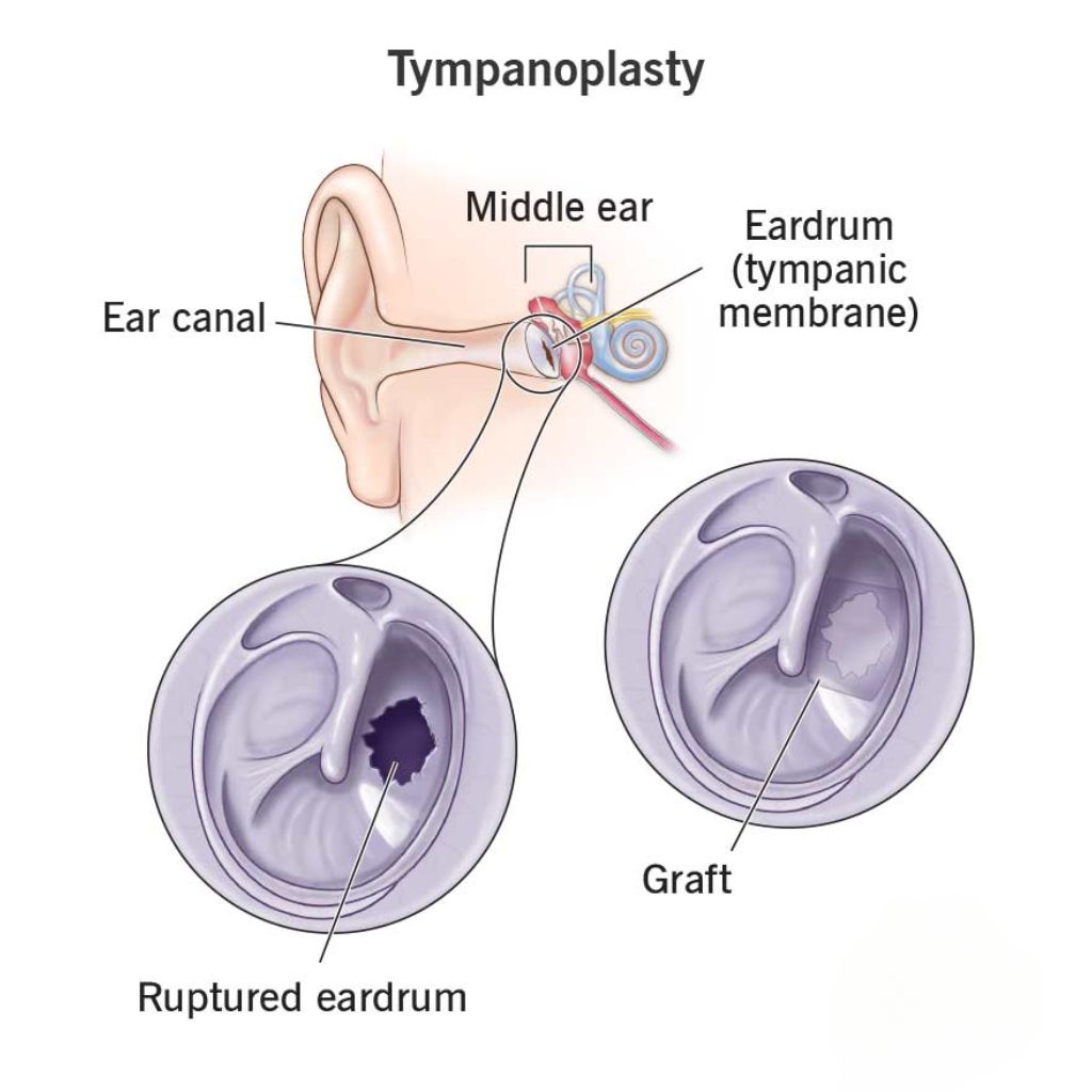 tympanoplasty or myringoplasty - Dr. Enu Malik Kukreja, ENT Specialist in Mumbai