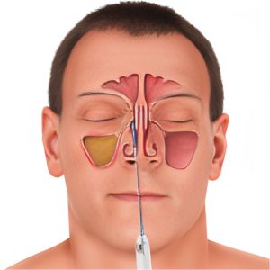 Balloon Sinuplasty - Sinus Specialist in Mumbai