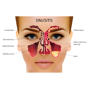 Sinusitis - Sinus Specialist in Mumbai