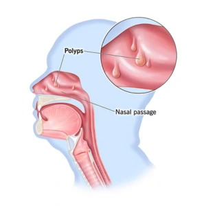 Nasal Polyps