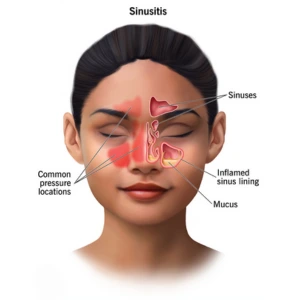 Acute and Chronic Sinusitis - Top ENT Problems in Monsoon