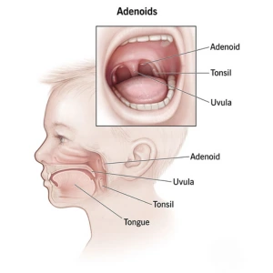 Adenoids