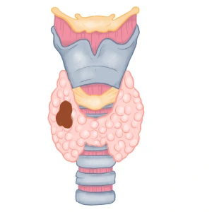 Head and Neck Cancer - Thyroid Gland Cancer
