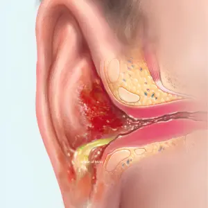 Ear Infections in Rainy Season - ENT problems in Monsoon