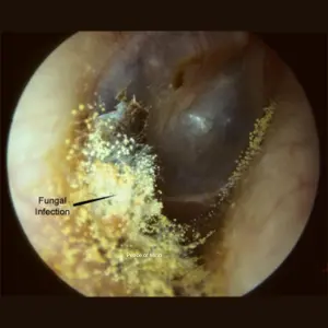Fungal Ear Infections - ENT problems in Monsoon