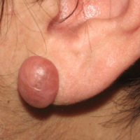 Keloid and Hypertrophied Scar Excision